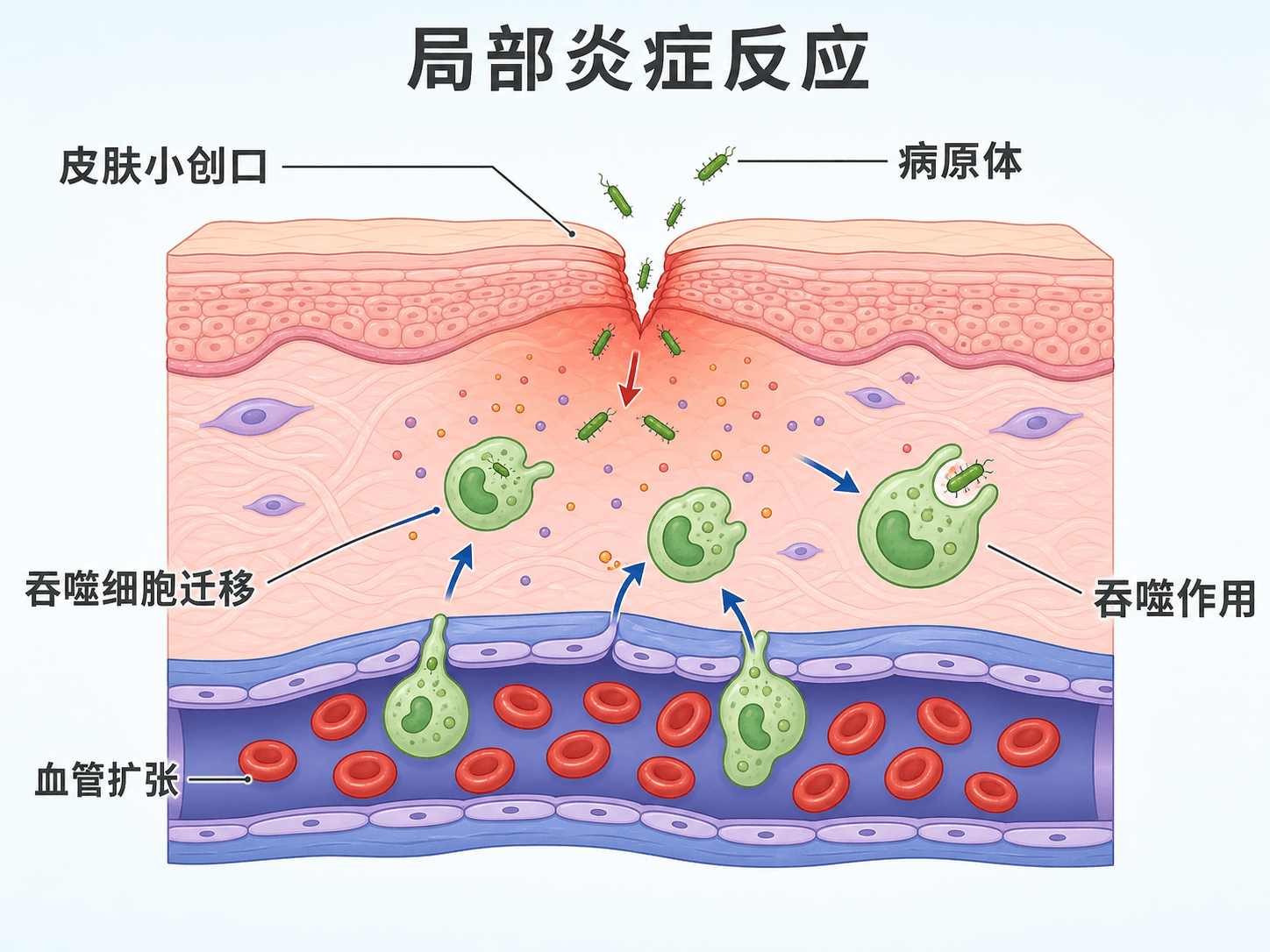 炎症反应过程图:皮肤破损后血管扩张、吞噬细胞聚集并吞噬病原体,中文教材风格